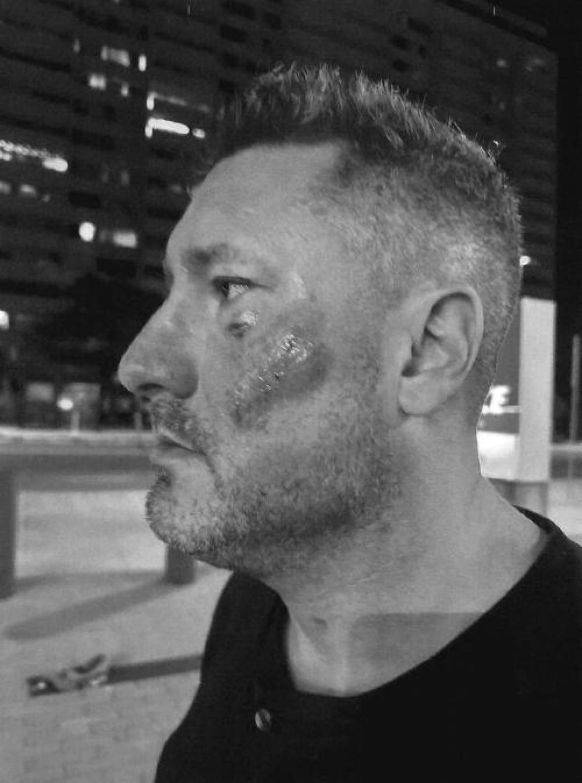Injuries on his face