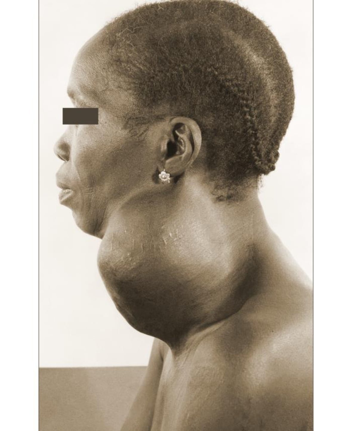 The Nigerian woman pictured here, displayed a marked swelling in the right neck region, which proved to be due to an extreme enlargement of her thyroid gland, in this case, known as a giant multinodular goitre.