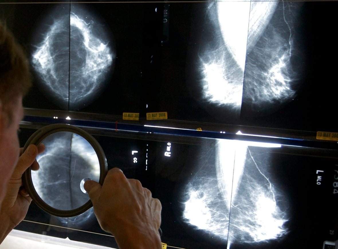 nl-mammography-results-20220824-1 radiologist looks at mammogram
