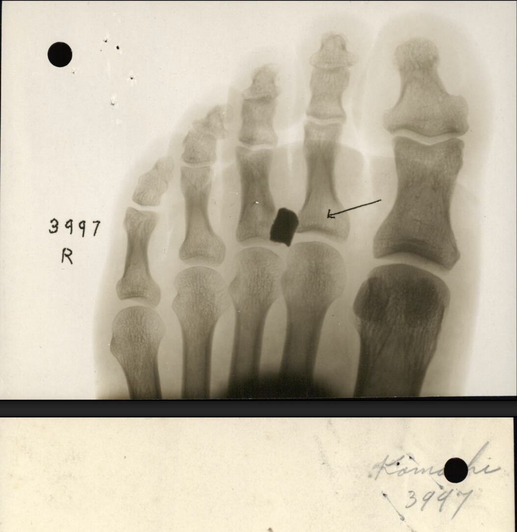 default-21 X-ray from the military records of retired Private Otoji Kamachi showing shrapnel in his foot from World War I.